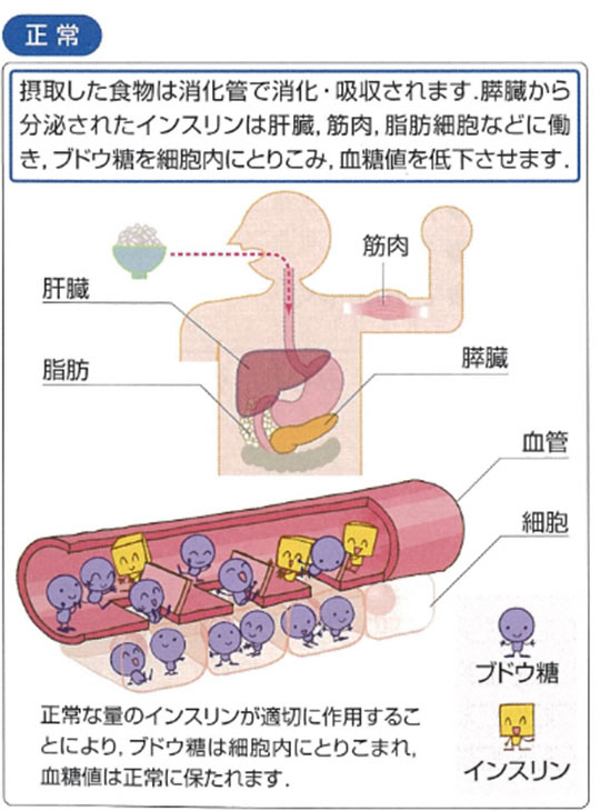 １型糖尿病