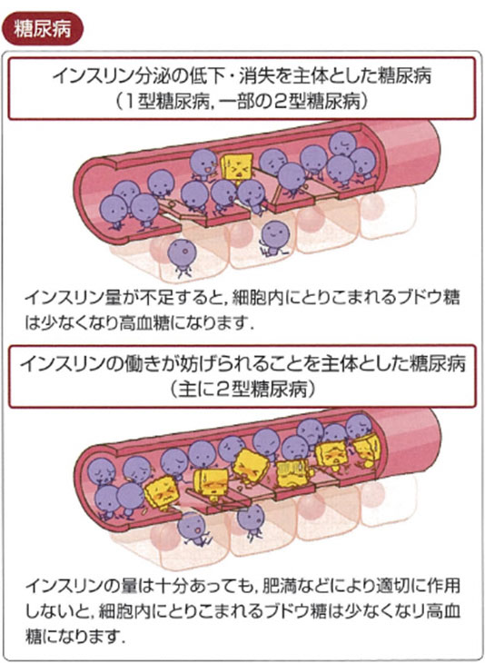 ２型糖尿病