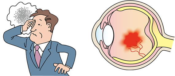 糖尿病性網膜症<